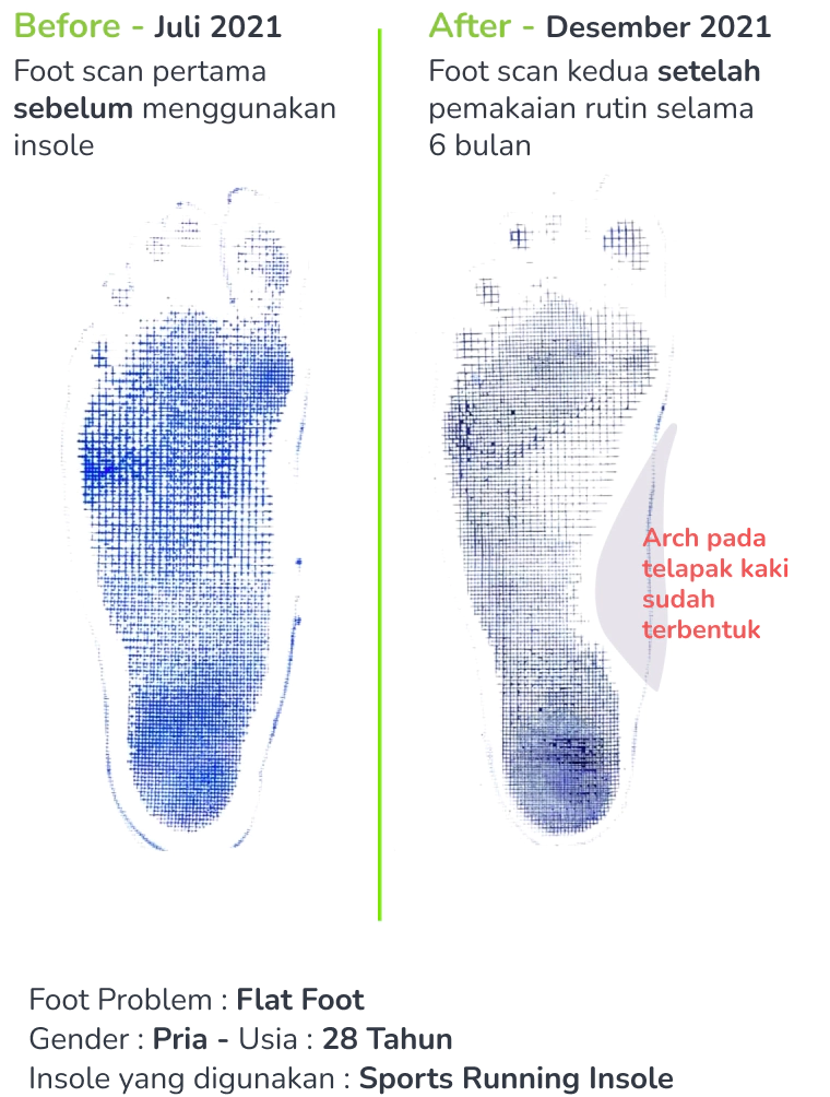 foto-kaki-flatfoot